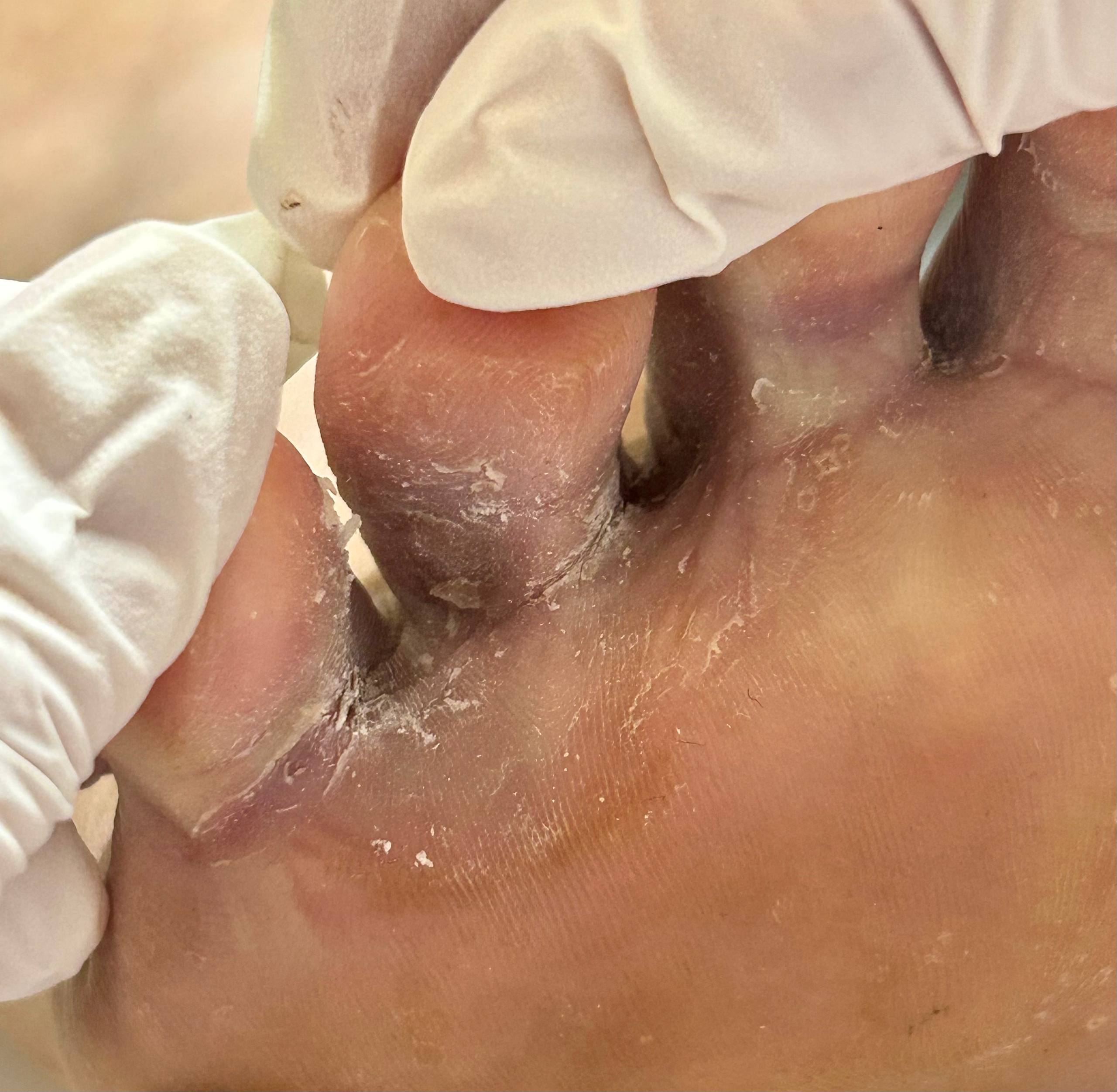 Пример микоза стопы