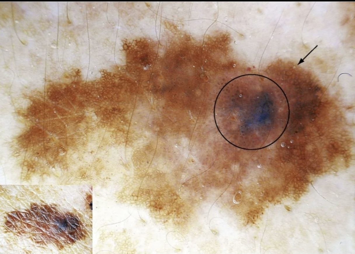 Дерматоскопическая картина подозрительного новообразования