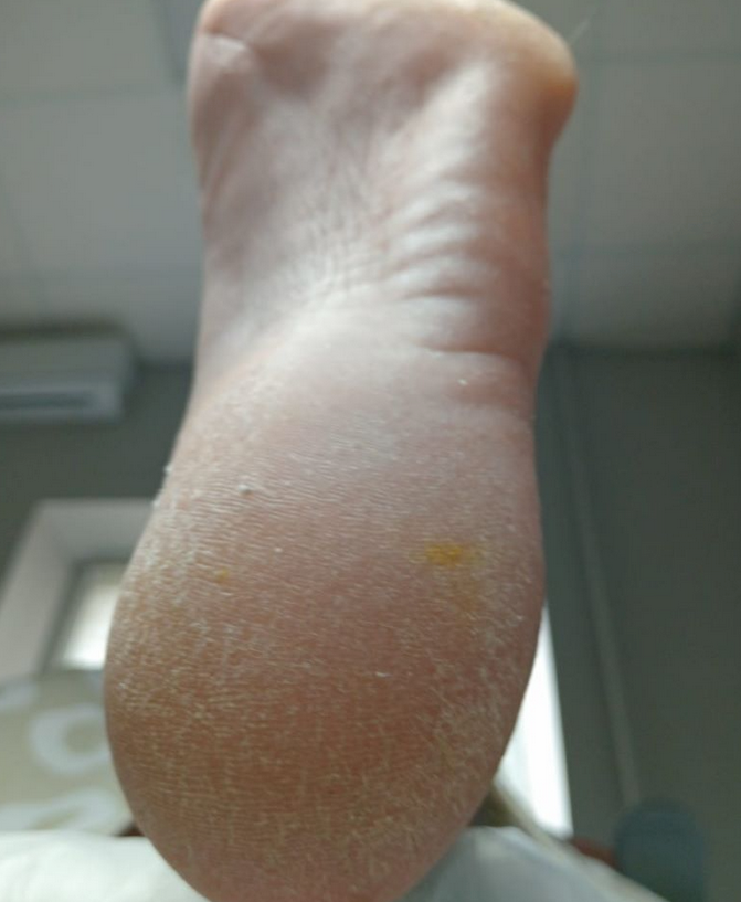 До лечения Подологический педикюр