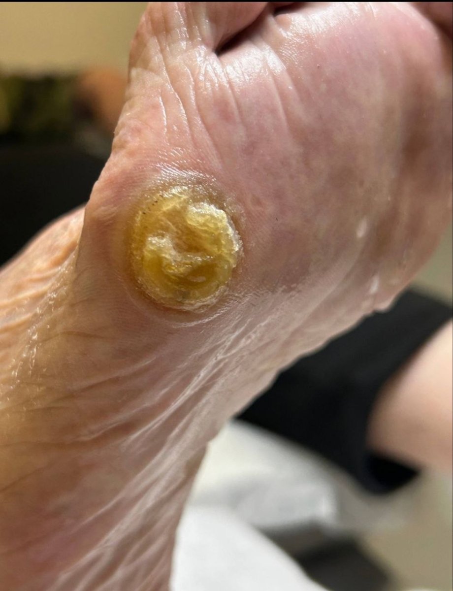 До лечения Мозоли