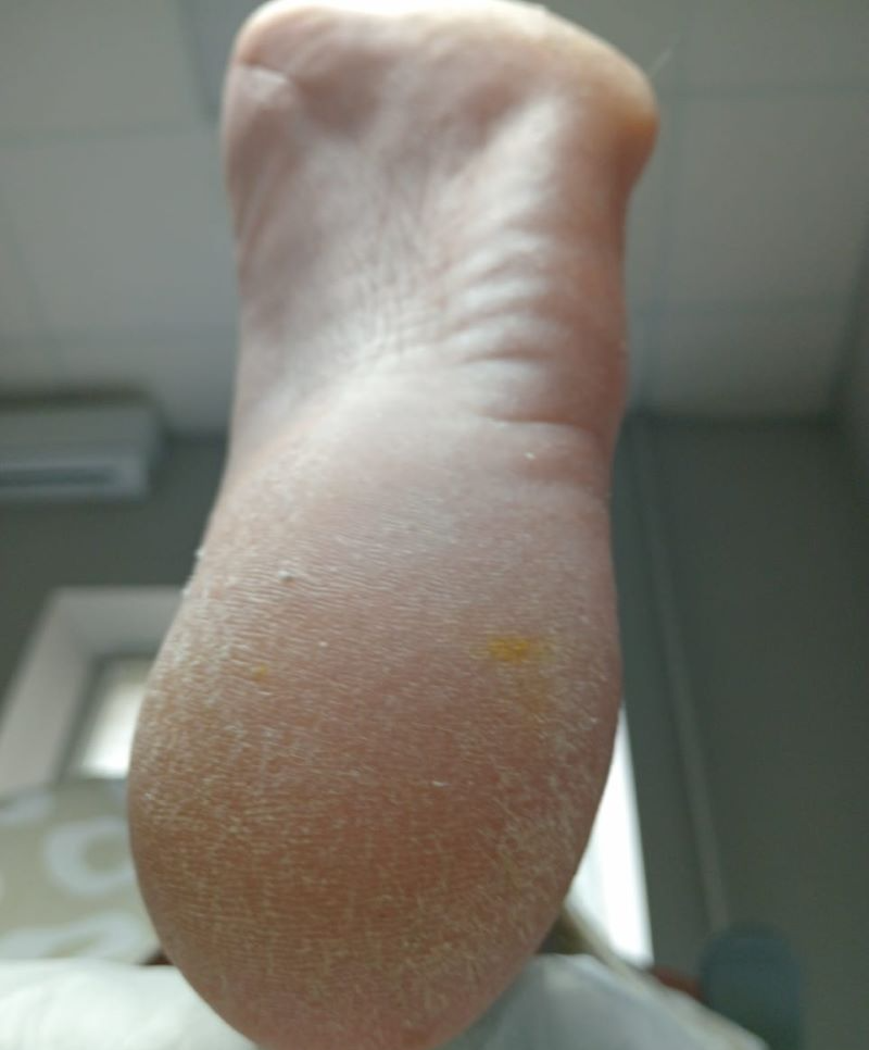 До лечения Грибок ногтей