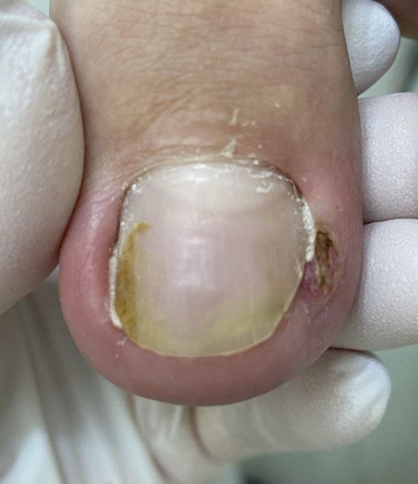 После лечения Вросший ноготь