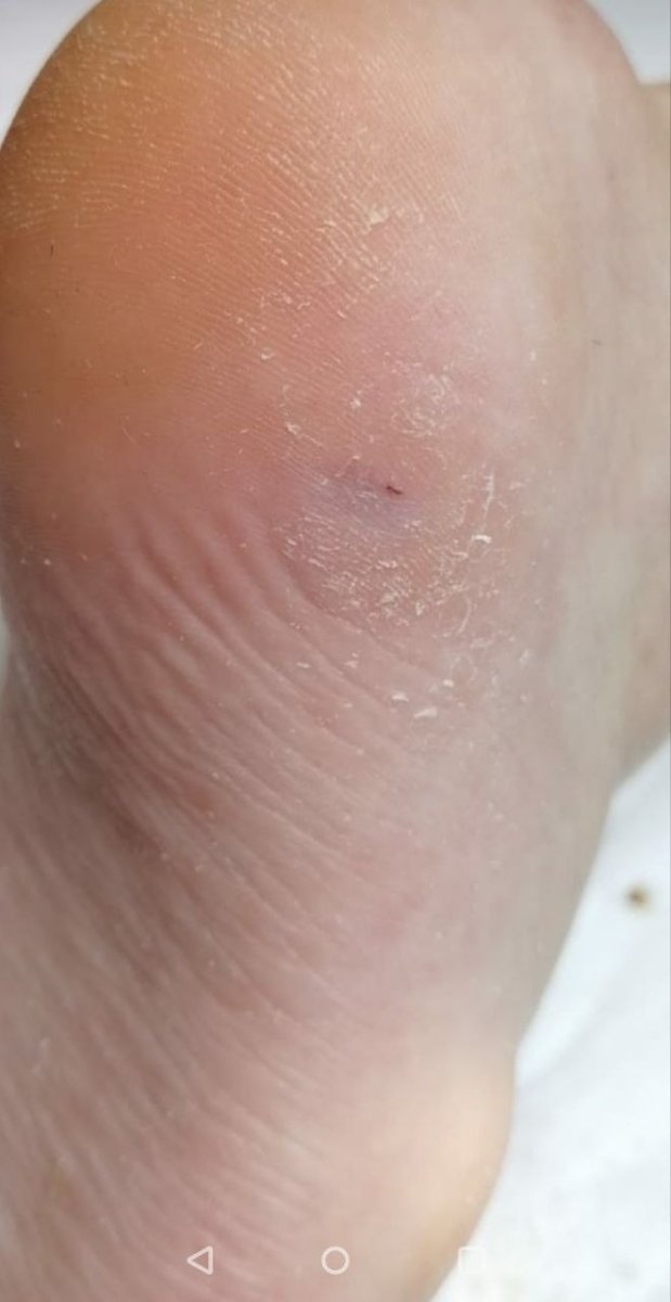 После лечения Бородавки